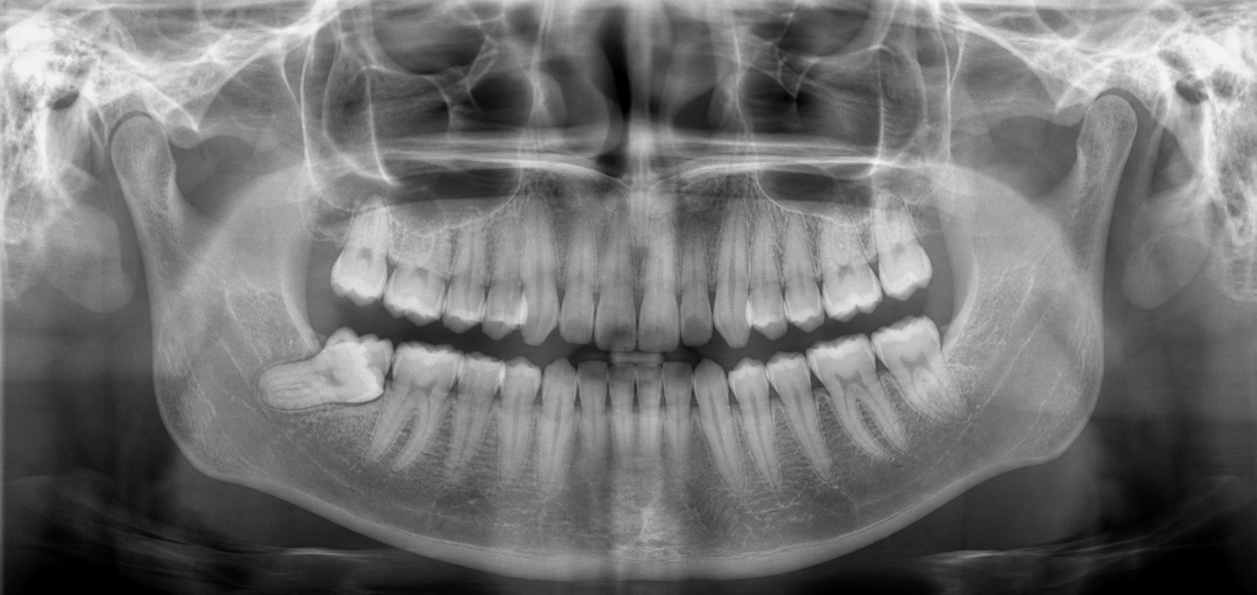 Illustrative panoramic OPG showing an impacted lower wisdom tooth